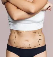 Abdominal liposuction
