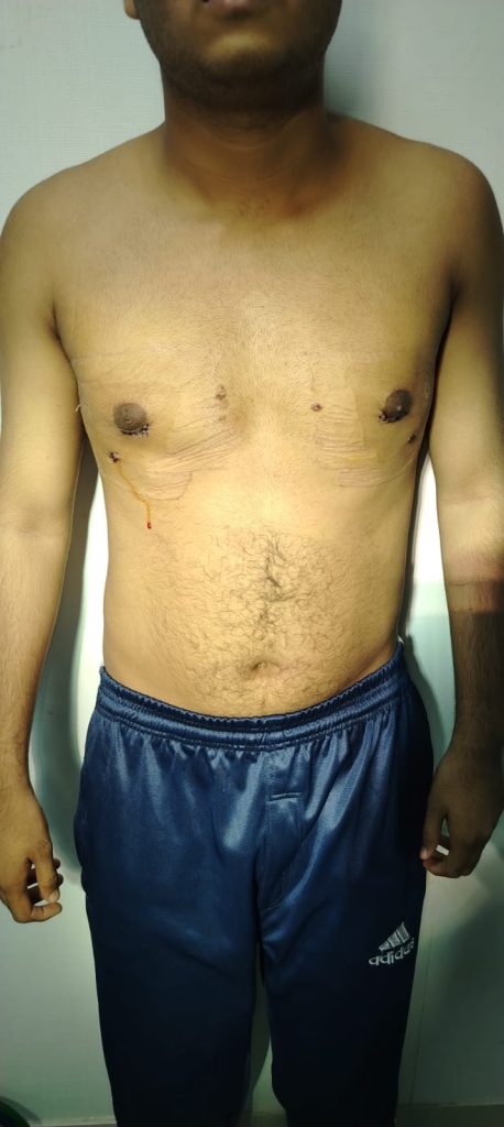 Gynecomastia — After