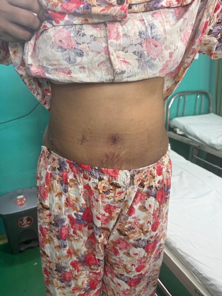 Tummy tuck — After