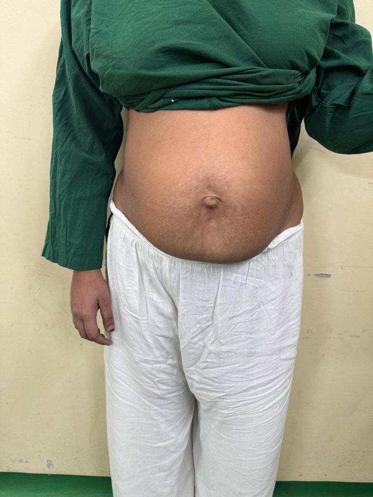 Tummy tuck — Before