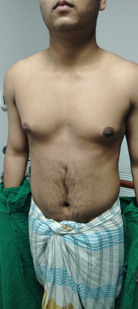 Gynecomastia — Before