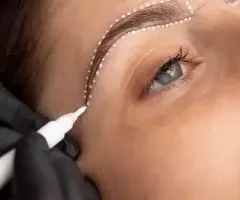 Brow Lift