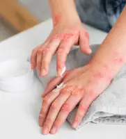 Burn and Contracture