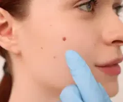 Mole Removal