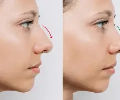 Nose V-line Contouring